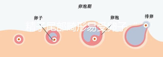 精子尾部畸形易受卵子“嫌棄”，無尾、短卷尾需重視