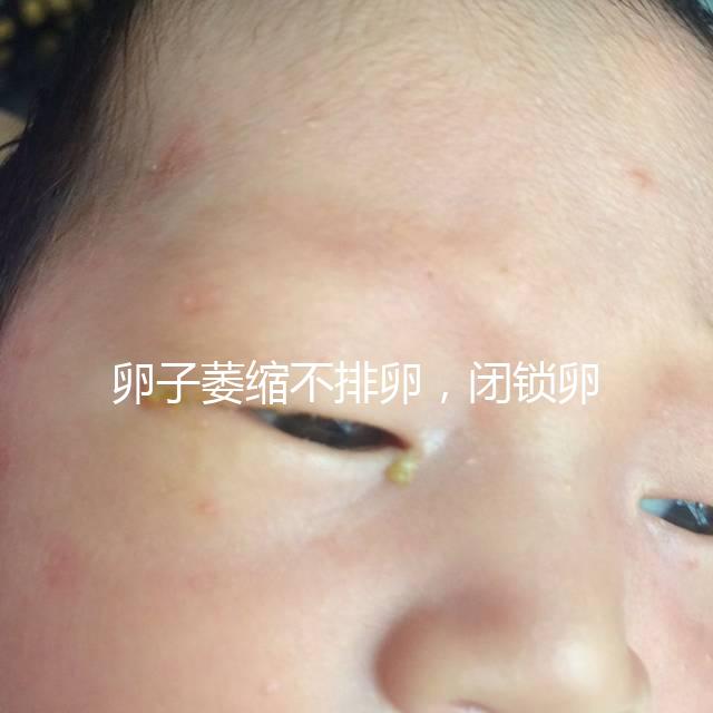 卵子萎縮不排卵，閉鎖卵泡形成原因與這4點有關