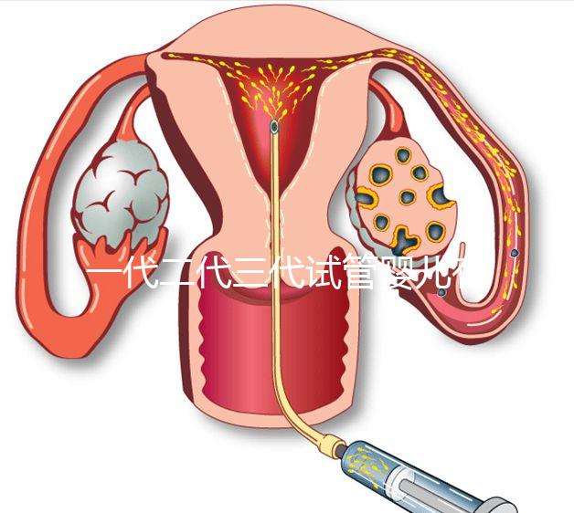 一代二代三代試管嬰兒有什么區(qū)別?