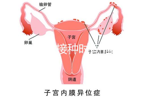 麻疹疫苗接種時間指南，初種年齡最好不要晚于這個月齡